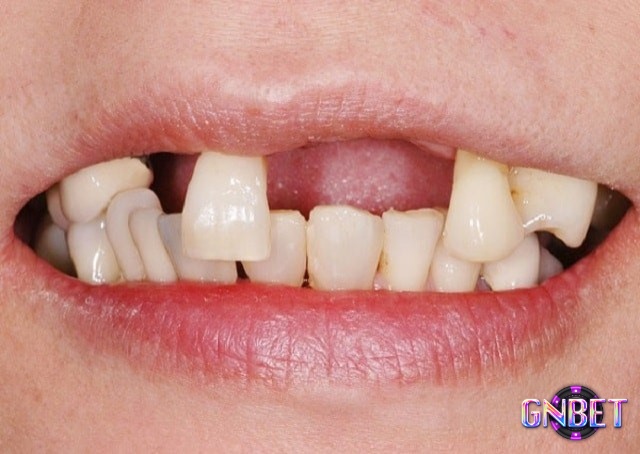 Mơ thấy rụng nhiều răng cùng lúc có điềm báo quan trọng về sức khỏe tinh thần của bạn