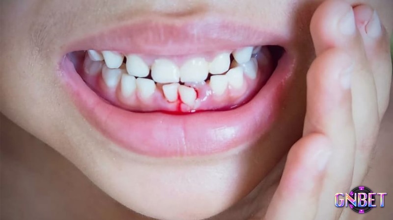 Giấc mơ thấy rụng răng chảy máu có điềm báo mạnh mẽ liên quan đến mất mát trong gia đình bạn